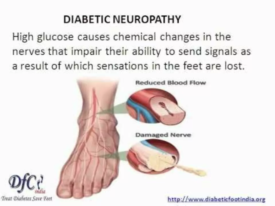 The Connection Between Diabetic Peripheral Neuropathy and Gastroparesis