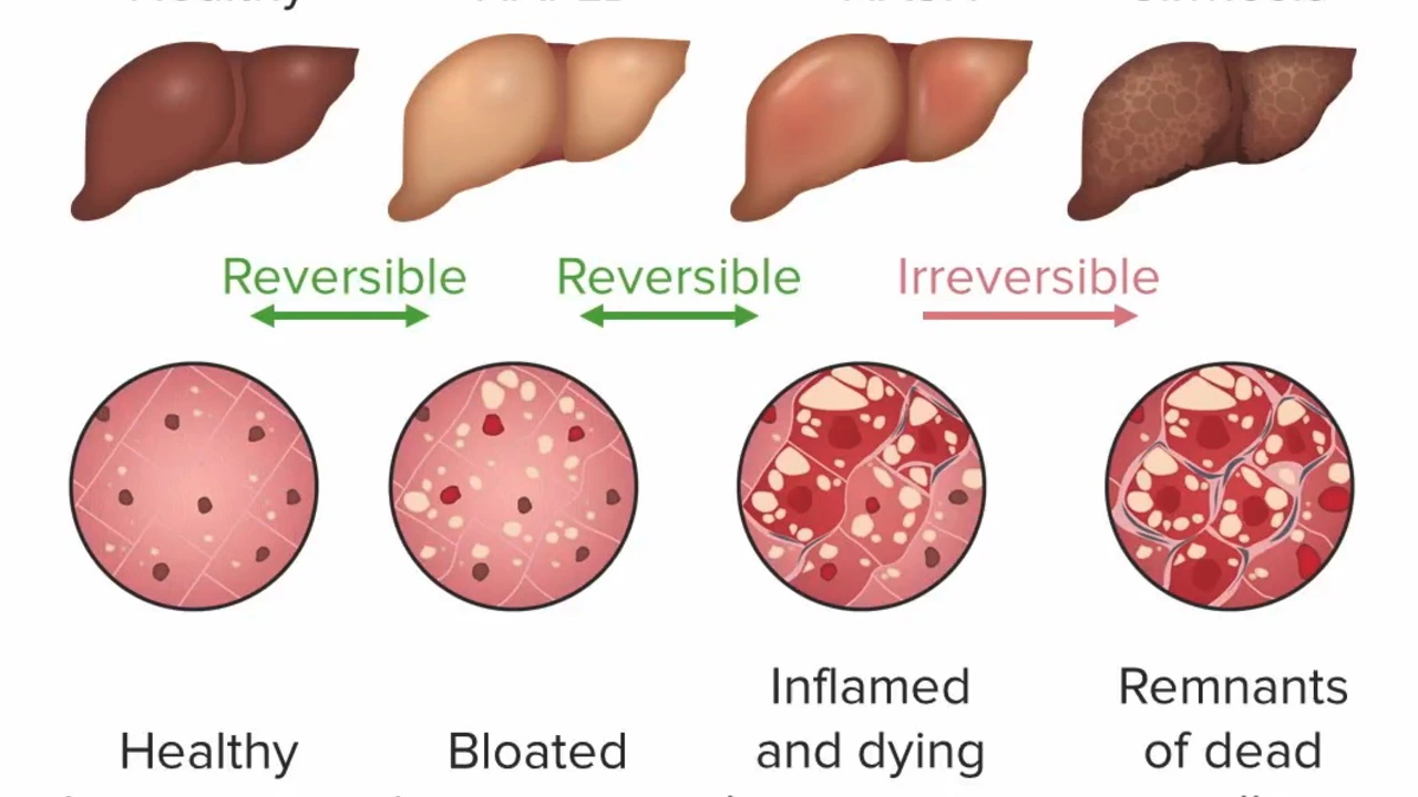 The Silent Epidemic of Non-Alcoholic Fatty Liver Disease